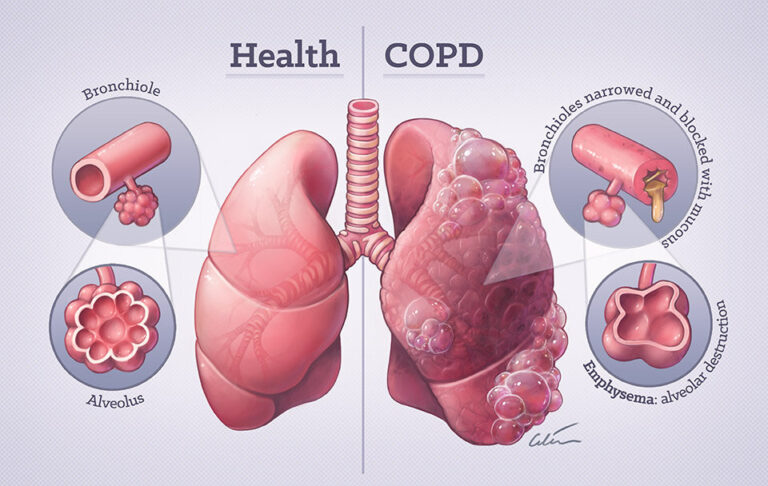 HealthyvsCOPDlungs960px.jpg